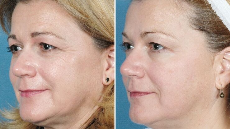 Φωτογραφίες πριν και μετά την αναζωογόνηση του δέρματος