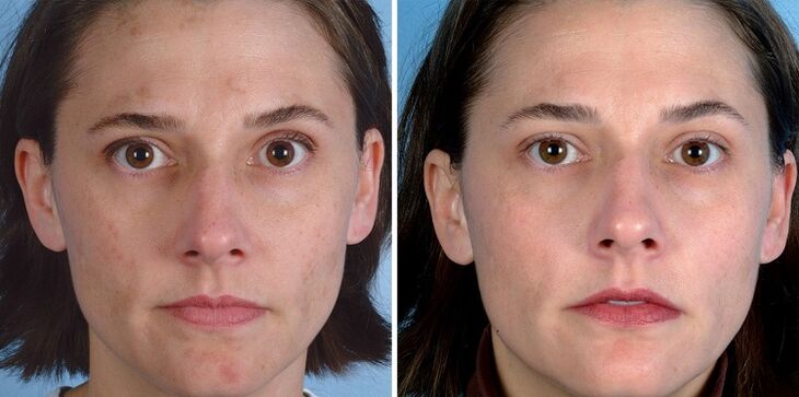 πριν και μετά την αναζωογόνηση του δέρματος με τη συσκευή